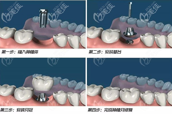 种植牙的植入过程动画展示图