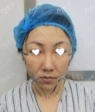 术前照片 术前照片