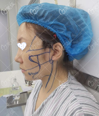 术前侧面照片 术前侧面照片