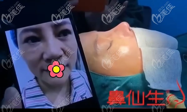 杭州群英整形外科高难度鼻修复案例和视频:我第3次做鼻子终于成功了