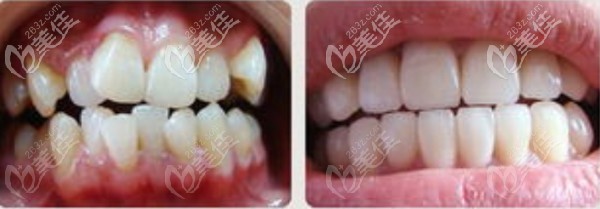 矫正案例--牙列拥挤