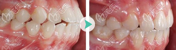矫正案例--龅牙
