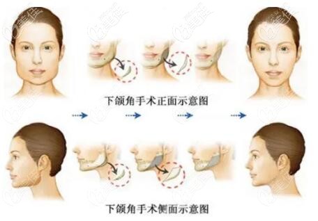 沈阳杏林做下颌角削骨手术怎么样