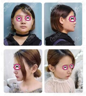 沈阳杏林朱石江下颌长曲线截骨术真人前后对比照