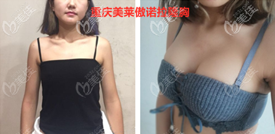重庆吴继东医生280CC傲诺拉隆胸对比照片
