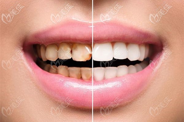 牙齿美白的前后效果