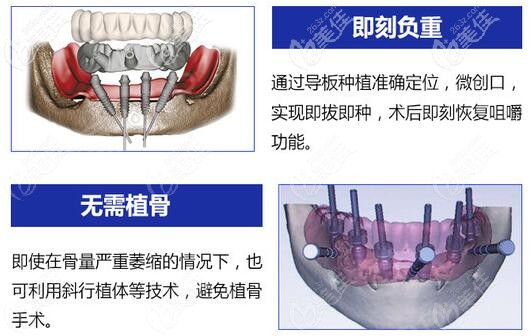 ALL-ON-4种植技术无需植骨粉