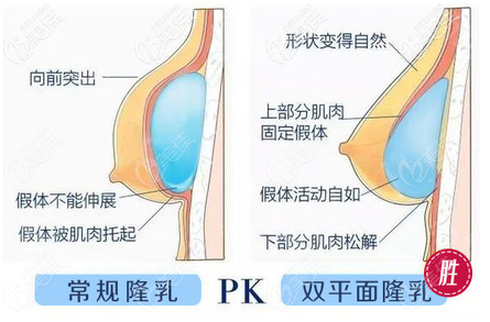 内窥镜双平面隆胸技术
