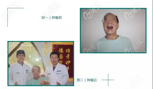 郑州唯美口腔医院种植牙咋样?老爸在这做的全口即刻种植牙当天就能用啦