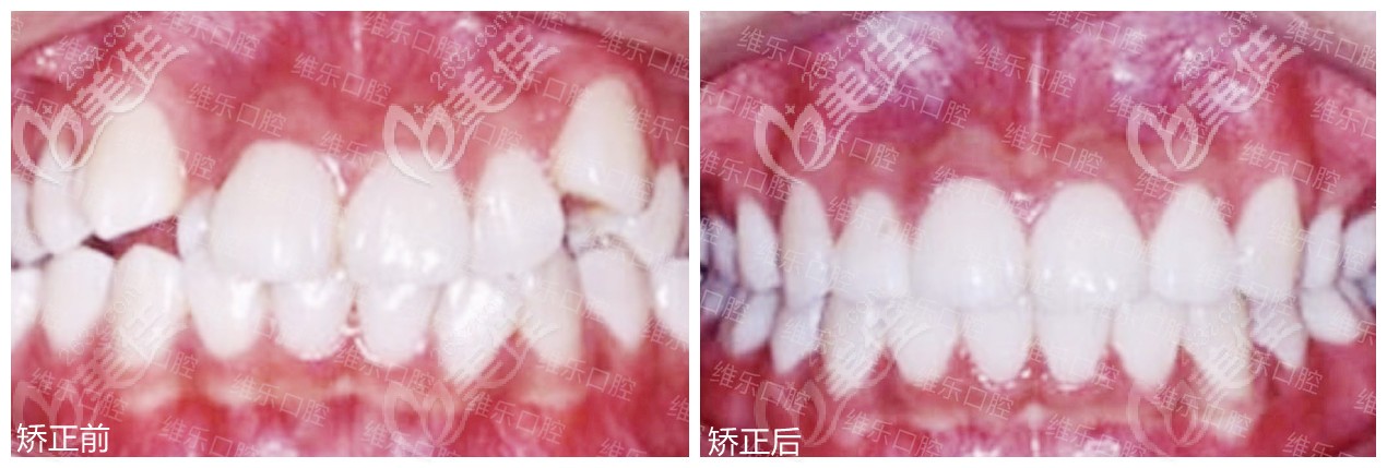 在福州维乐口腔矫正前后对比 在福州维乐口腔矫正前后对比
