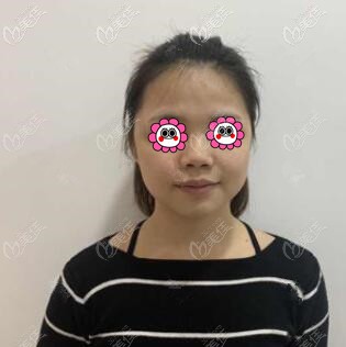 做鼻综合术前照 做鼻综合术前照