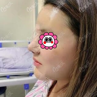 鼻综合术后第1天效果照 鼻综合术后第1天效果照