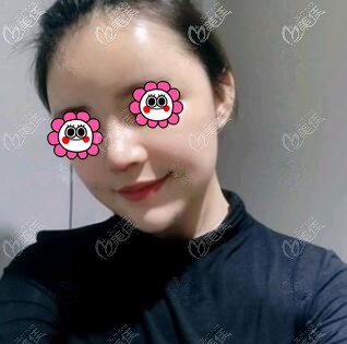 鼻综合术后第8天 鼻综合术后第8天