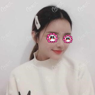 鼻综合整形术后15天效果照 鼻综合整形术后15天效果照