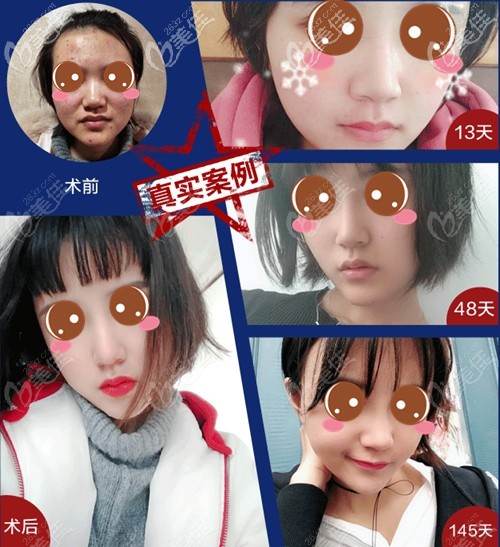 武汉美基元射极峰膨体鼻修复案例