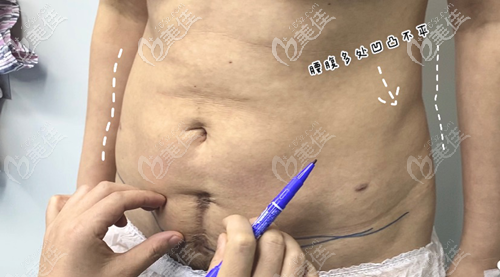 腰腹环吸凹凸不平图片 腰腹环吸凹凸不平图片