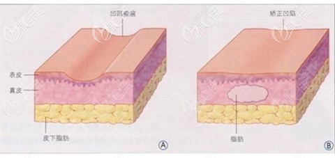 腰腹环吸后凹凸不平修复 腰腹环吸后凹凸不平修复