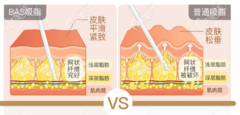 医院吸脂优势 医院吸脂优势