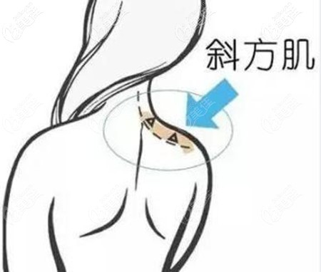 背部吸脂包括斜方肌