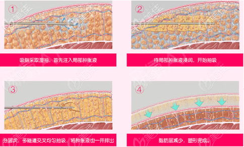 上海华美何斌吸脂如何