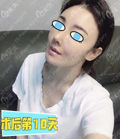 鼻修复术后十天效果