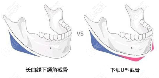 长曲线下颌角截骨和U形截骨有什么区别