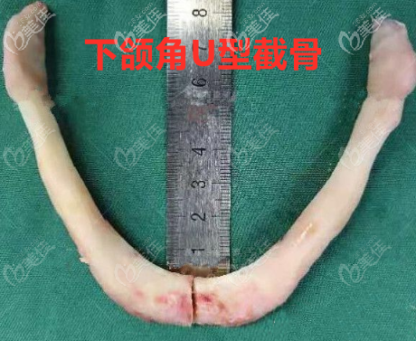 下颌U型截骨术