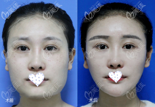 下颌角长曲线截骨正面效果图对比