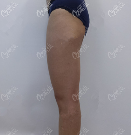 我在北京英煌做大腿吸脂前 我在北京英煌做大腿吸脂前