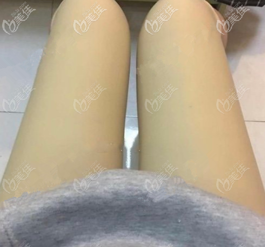 <!--<i data=20240703-sp></i>-->给我做大腿抽脂第3天 <!--<i data=20240703-sp></i>-->给我做大腿抽脂第3天