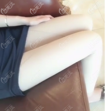 做完腿部吸脂有半个多月了 做完腿部吸脂有半个多月了