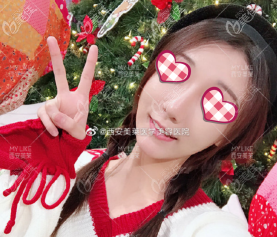 你问我西安美莱做鼻子怎么样，我只能说高难度鼻综合都不在话下哦