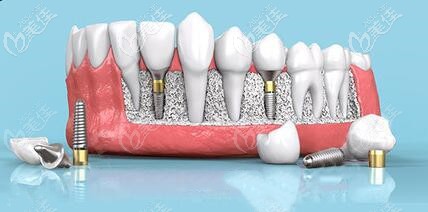 瑞典诺贝尔种植体类型多，适应症广泛