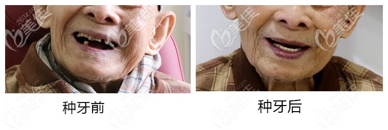 百岁老人种牙前后<span style=