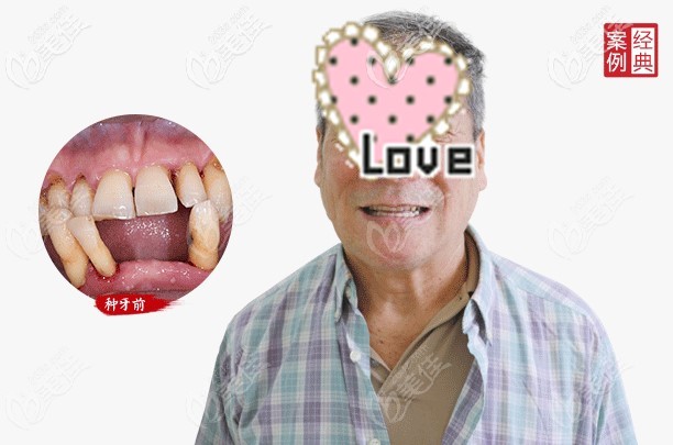 重度牙周炎的黎叔叔体验了即刻负重种植牙 重度牙周炎的黎叔叔体验了即刻负重种植牙