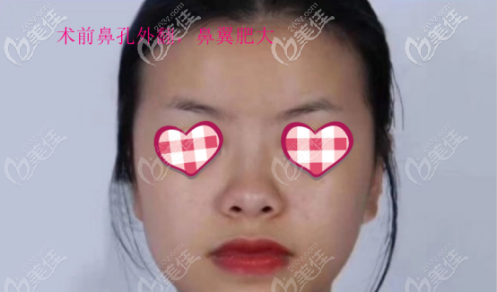曾熬做鼻子的案例一术前照片 曾熬做鼻子的案例一术前照片