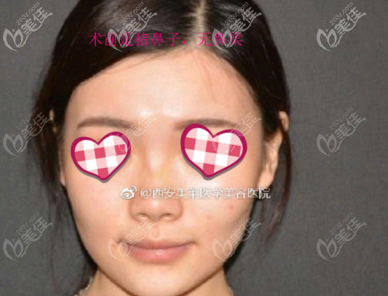 曾熬医生做鼻子的案例二术前照片 曾熬医生做鼻子的案例二术前照片