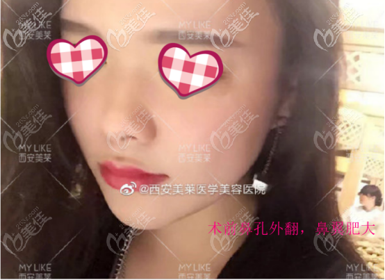 曾熬医生做鼻子的案例三术前照片 曾熬医生做鼻子的案例三术前照片