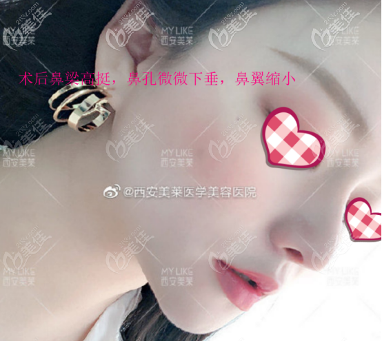 曾熬医生做鼻子的案例三术后照片 曾熬医生做鼻子的案例三术后照片