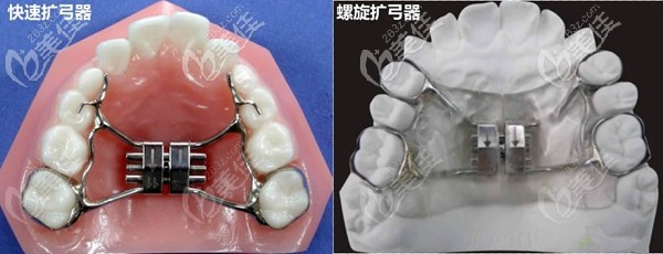 扩弓器矫正方式
