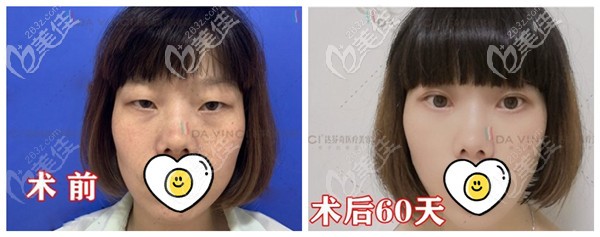 广元达芬奇全切双眼皮+上睑下垂矫正案例 广元达芬奇全切双眼皮+上睑下垂矫正案例