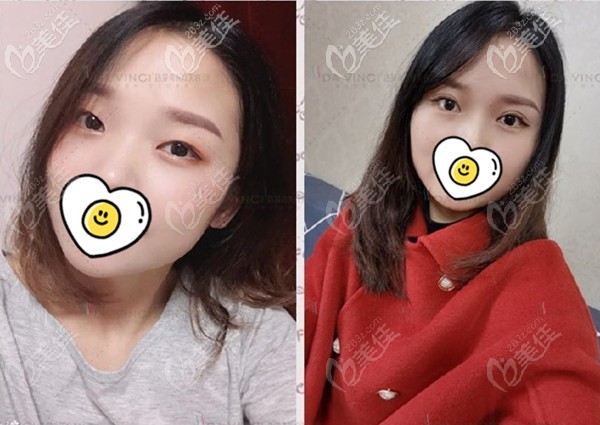 这有在广元达芬奇割全切双眼皮案例图片,你猜她们是多久变自然的