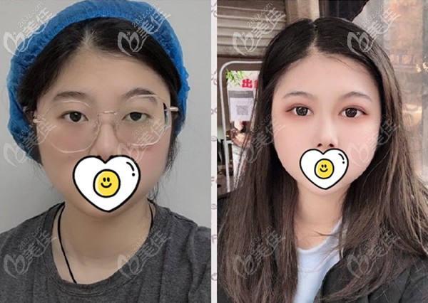 达芬奇双眼皮术前术后对比图片 达芬奇双眼皮术前术后对比图片