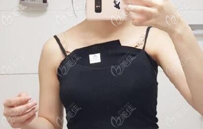 我奥美定丰胸18年取出后的样子 我奥美定丰胸18年取出后的样子