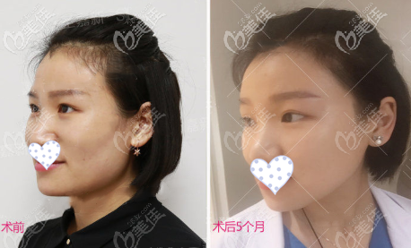 超长曲线下颌角截骨案例侧脸效果