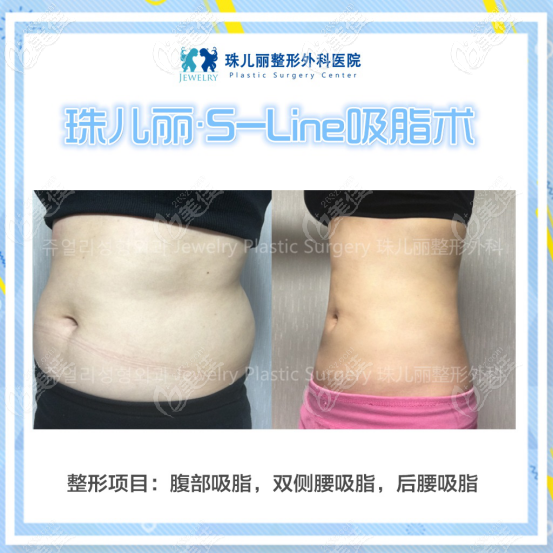 韩国珠儿丽吸脂案例 韩国珠儿丽吸脂案例