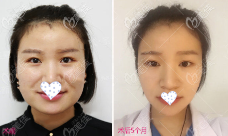 下颌角超长曲线截骨正面效果图