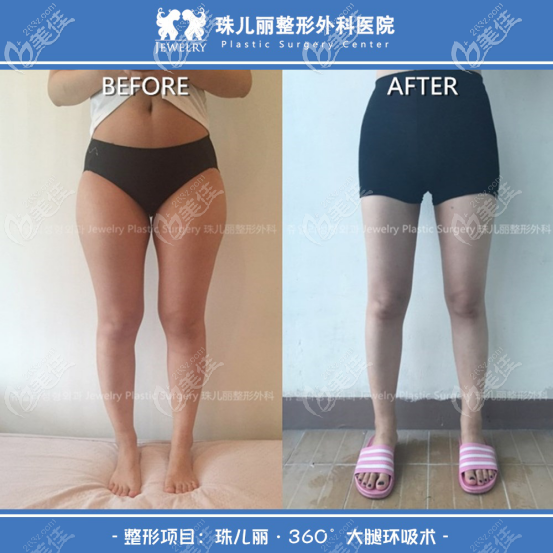 韩国珠儿丽吸脂大腿小腿吸脂案例 韩国珠儿丽吸脂大腿小腿吸脂案例