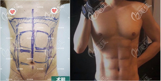 国内吸脂案例 国内吸脂案例