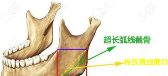 超长曲线截骨示意图